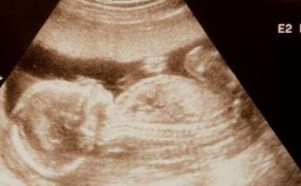 女性子宫肌瘤在北京大学第三医院做三代试管预算八万块够不够？