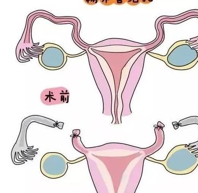 女性宫颈环扎术全过程分享，术后注意事项也不容忽视